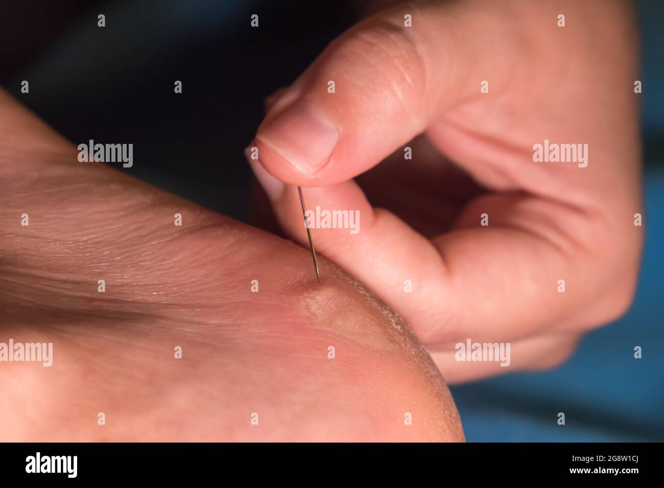 Women's fingers pierce a callus on the heel with a needle. Close-up Stock Photo