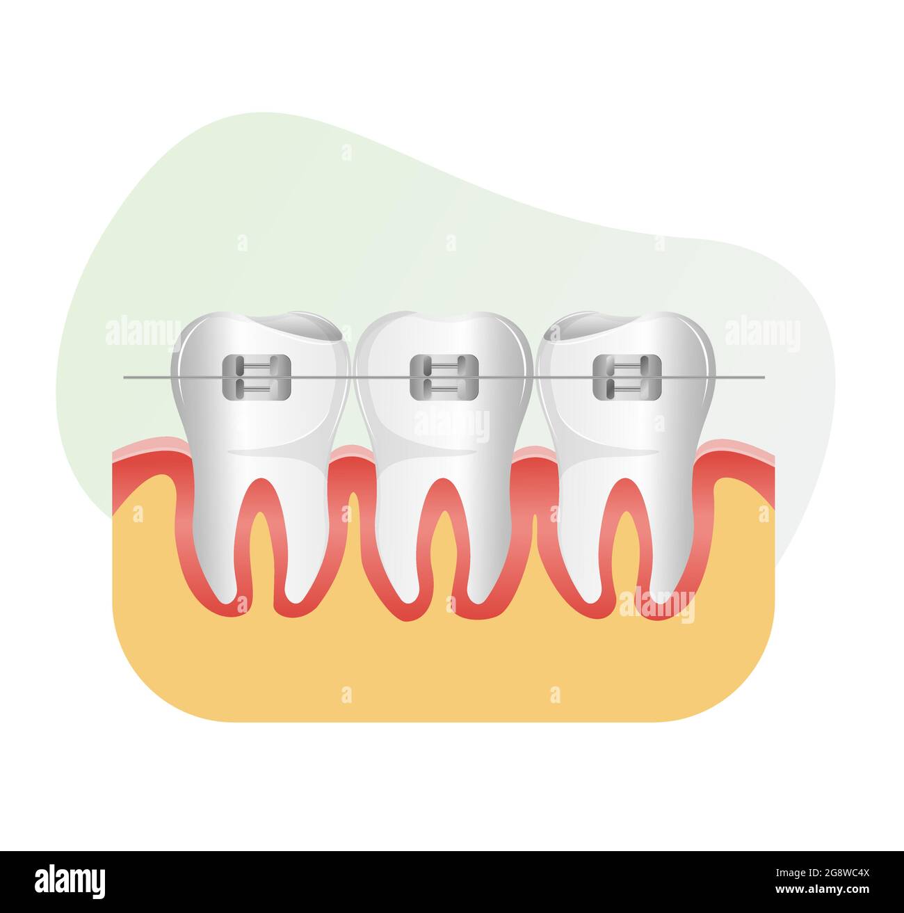 Set of Teeth with Dental Braces stock illustration as EPS 10 File