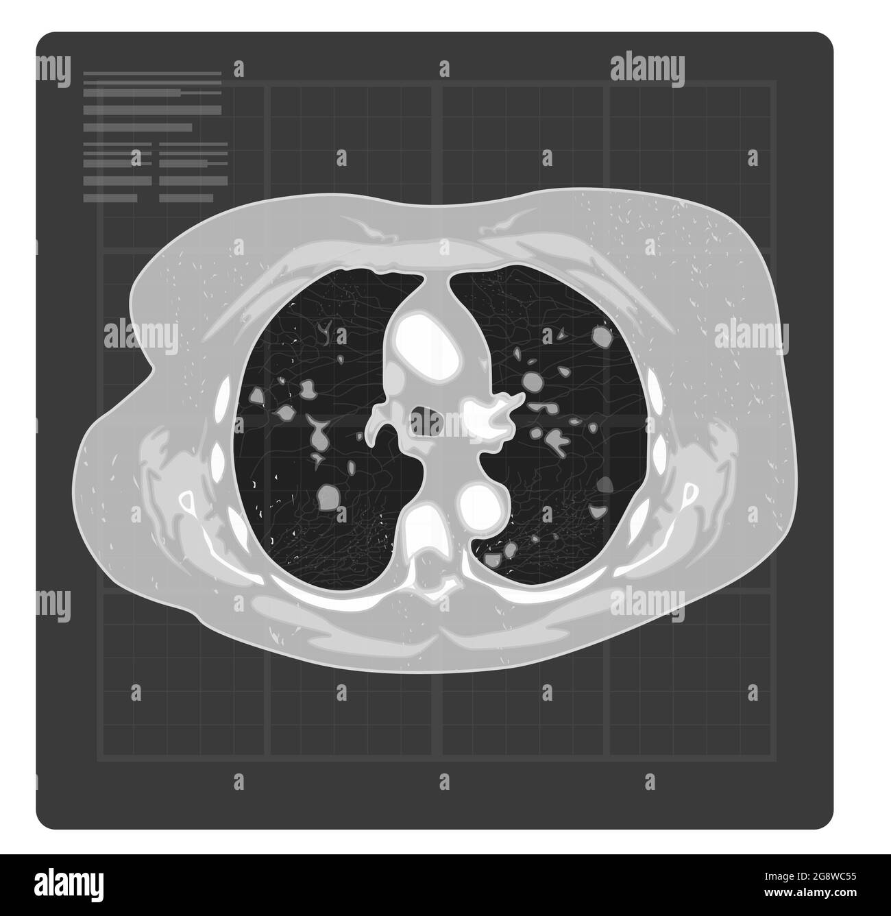 Covid-19 Testing - Human Lungs X-Ray - Illustration as EPS 10 File Stock Vector