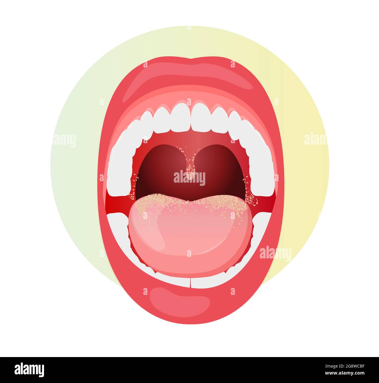 Open Mouth with Fungal Infection on Tongue - stock illustration as EPS 10 File Stock Vector