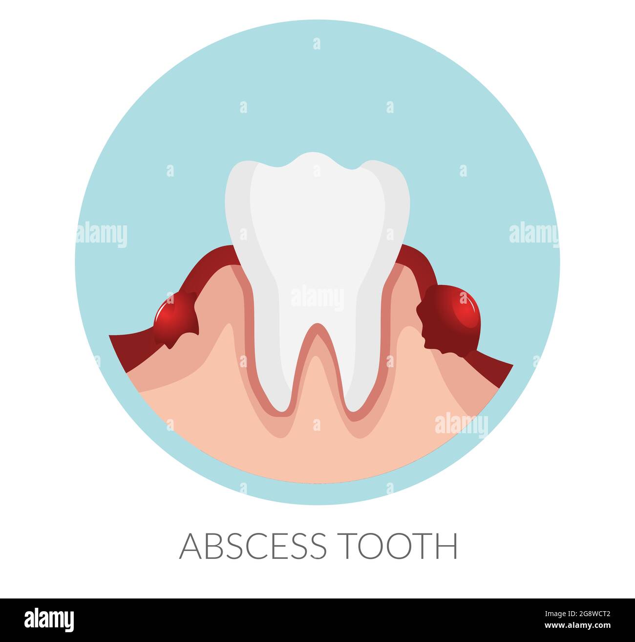 Dental abscess hi-res stock photography and images - Alamy