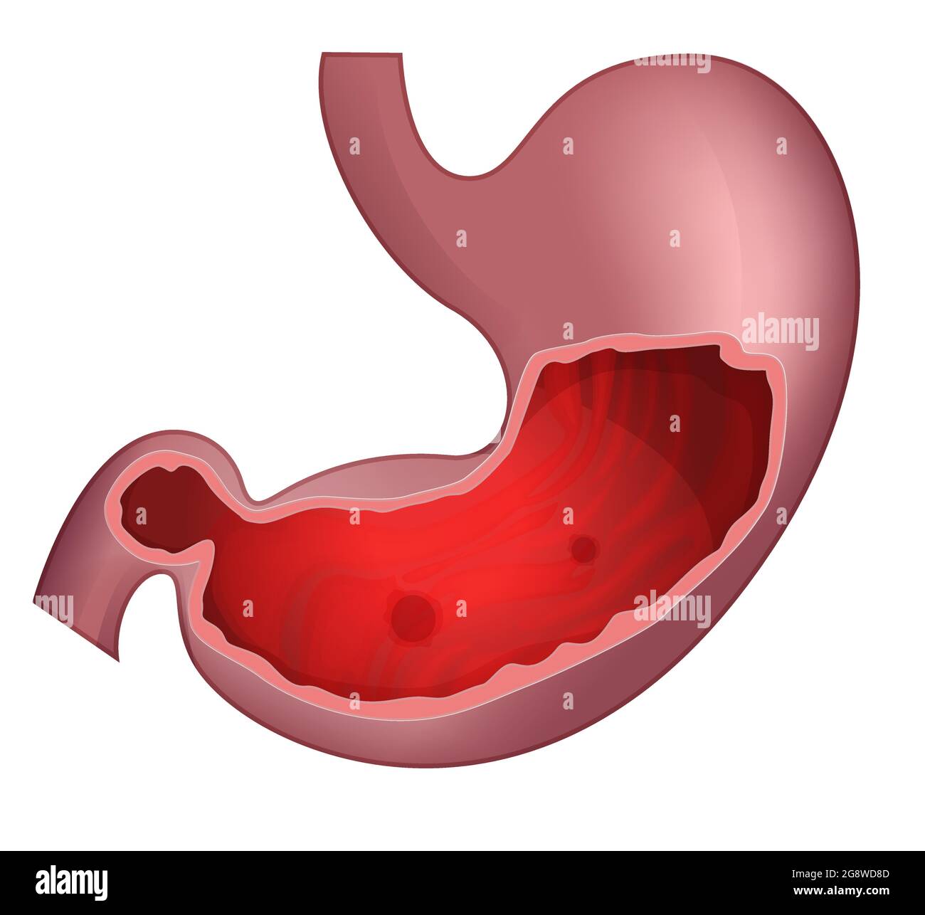 Peptic Ulcer Stomach Ache Illustration as EPS 10 File Stock Vector