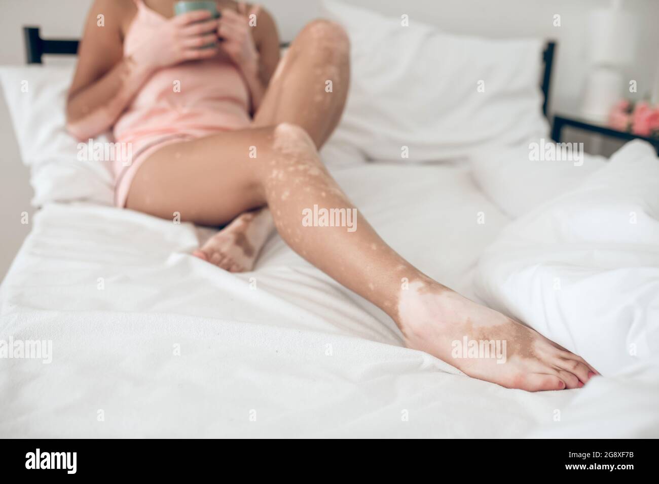 Dark-skinned woman with skin pigmentation lying in bed Stock Photo