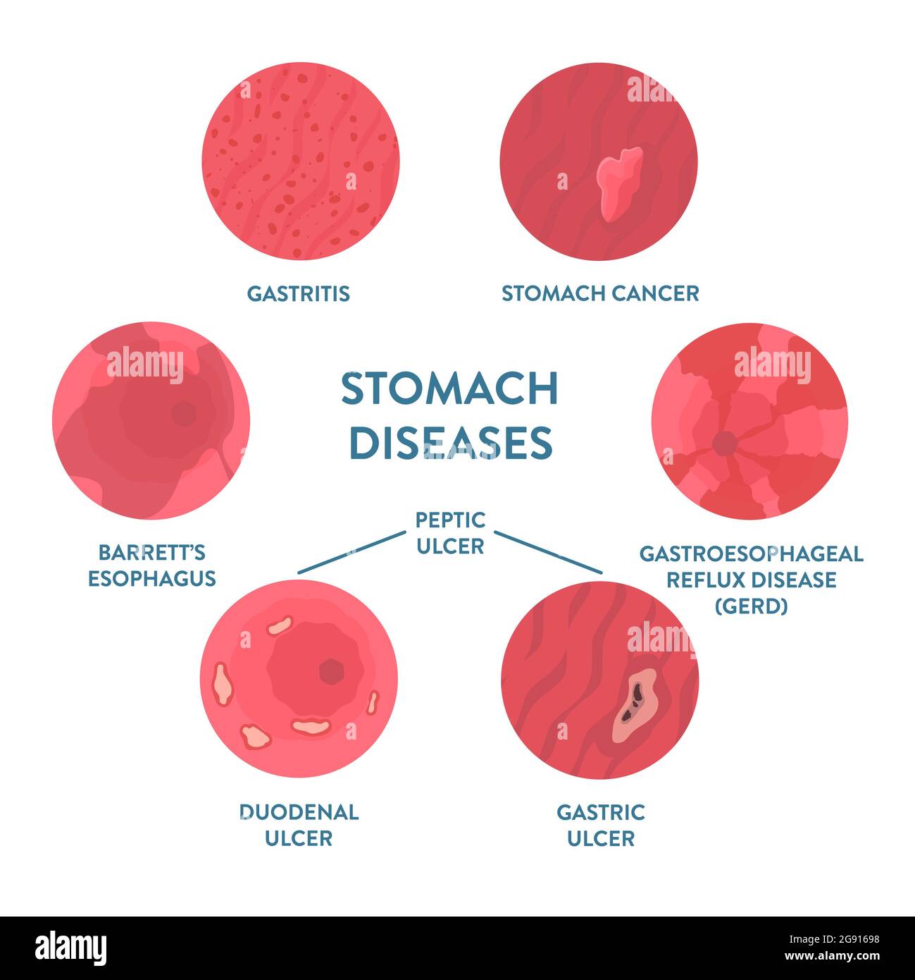 Stomach diseases, illustration Stock Photo