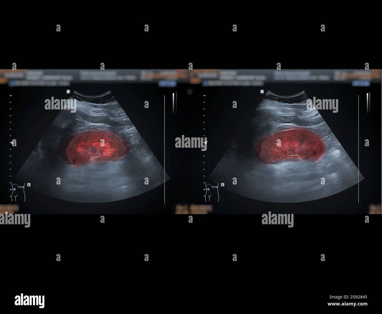 Ultrasound upper abdomen showing   kidney for screening  renal disease. Stock Photo