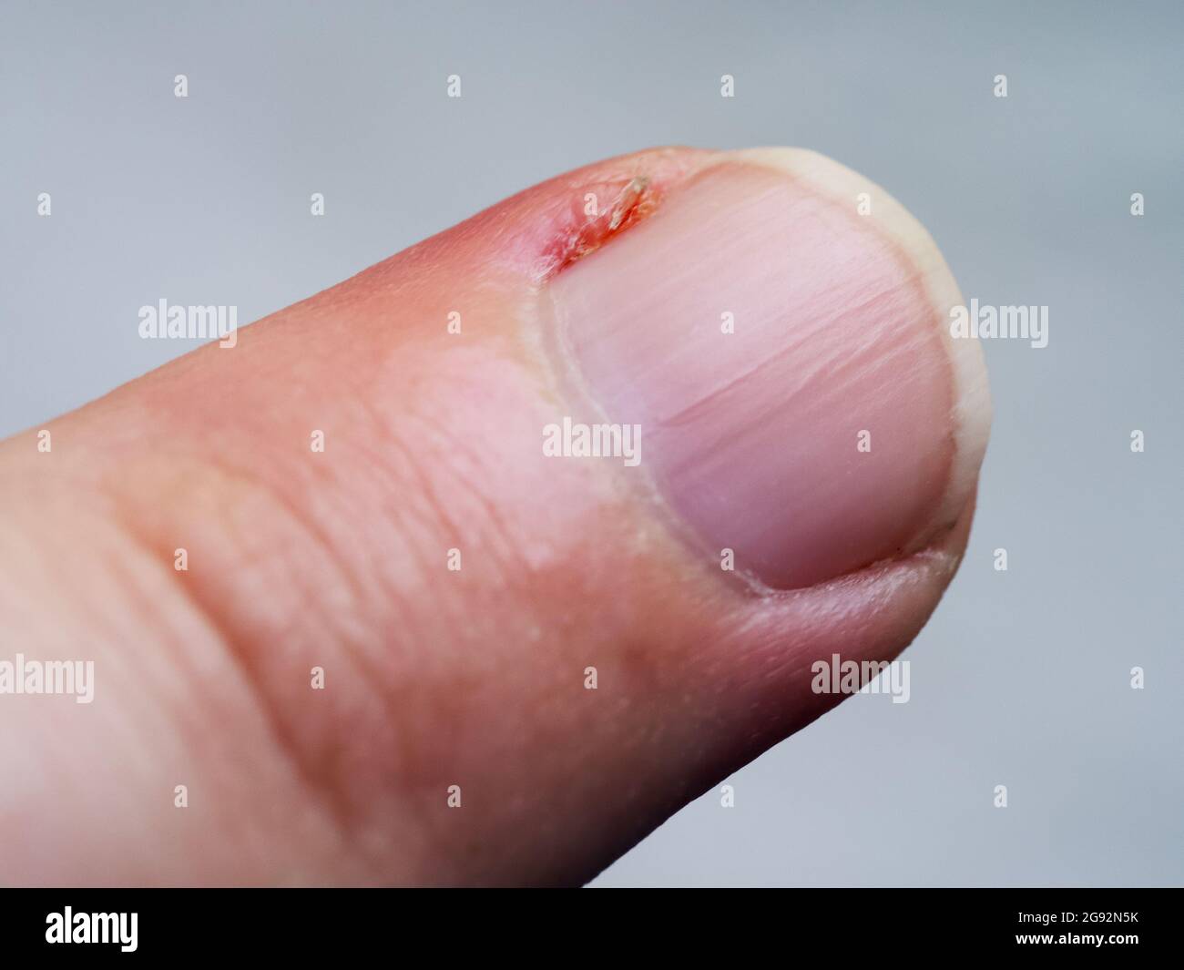 Inflamed cuticle on the finger. Damaged part of the finger, close-up. Stock Photo