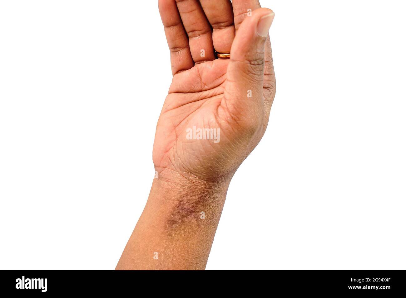 close up view of asian women hand with light sunburn marks dermatitis problem of rash ,Allergy rash Stock Photo