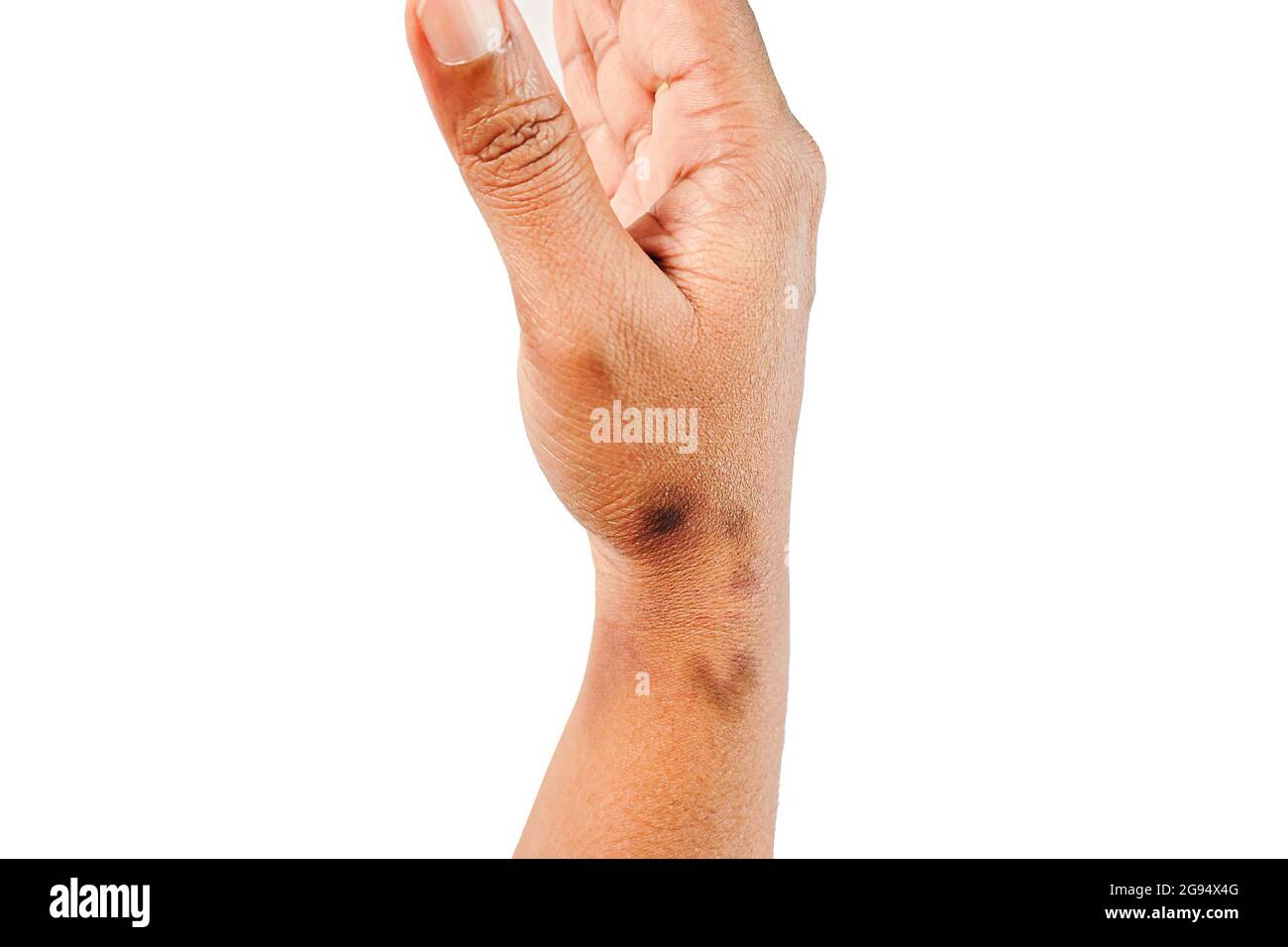 Allergic rashes hires stock photography and images Alamy
