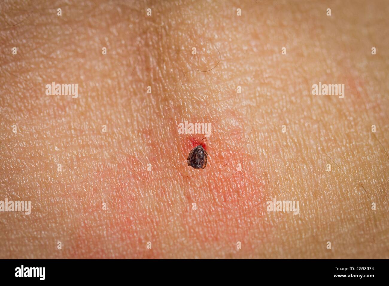 Dangerous tick over the skin closeup view Stock Photo