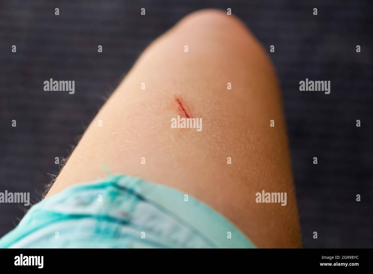 Fresh wound on the leg, thigh with blood. Skin texture. Body positive - body hair. Woman's leg. The red scratch is bleeding. First aid. Black Stock Photo