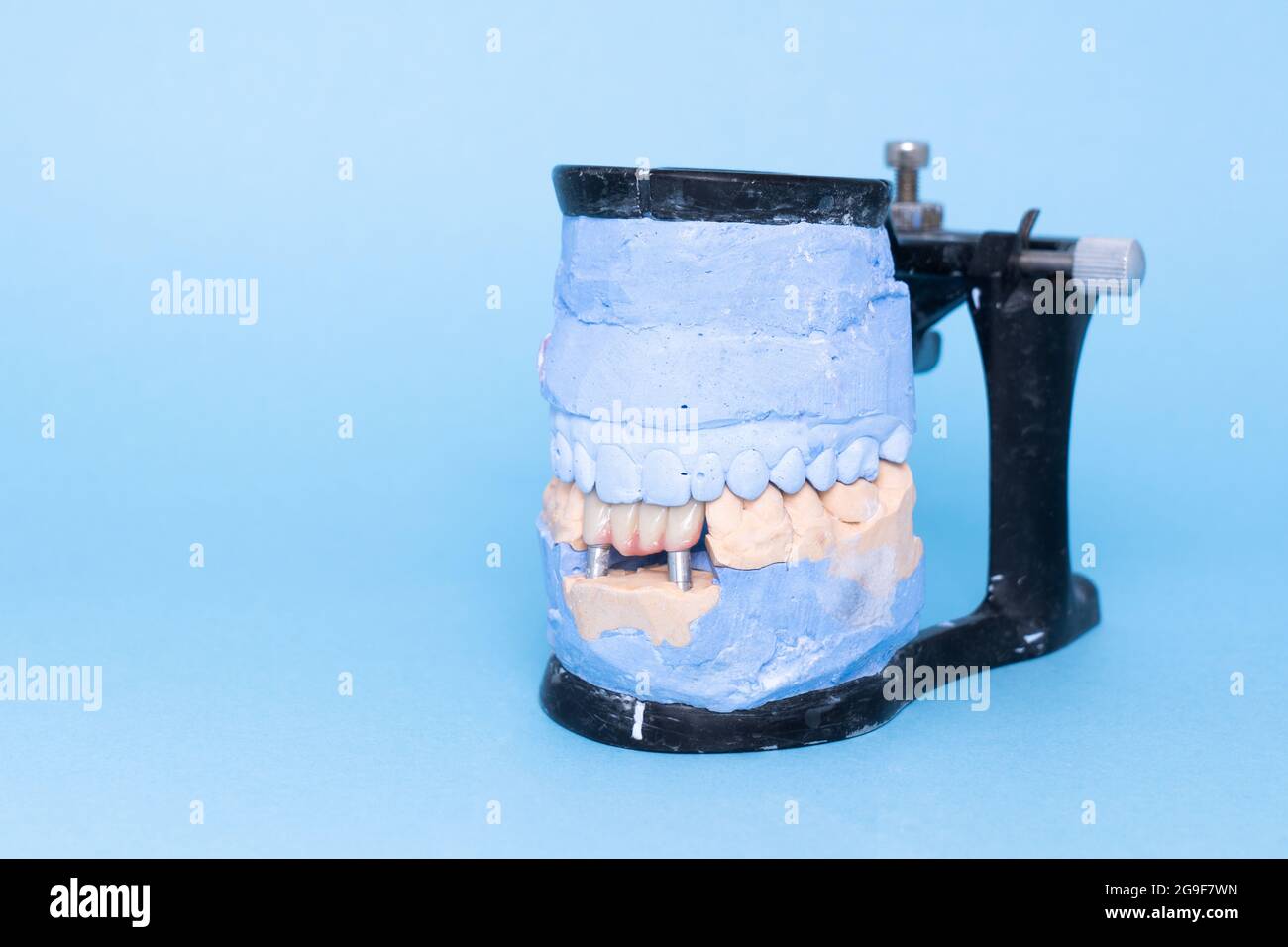 Veneers and crowns on gypsum dental artificial jaw on blue background. Upper and lower jaws plaster model with prepared teeth on diagnostic model Stock Photo