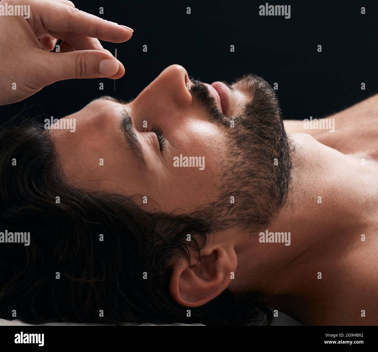 Acupuncture treatment for migraines and headaches. Closeup of