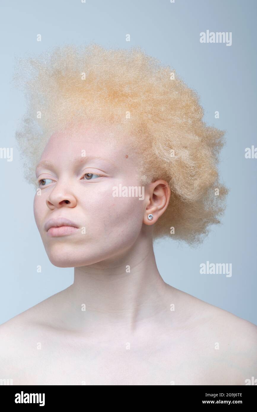 African albino woman hi-res stock photography and images - Alamy