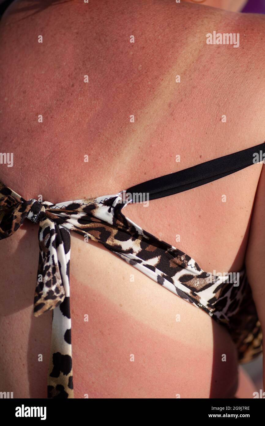 the red back of an adult woman with a sunburn and white lines from a swimsuit  Stock Photo