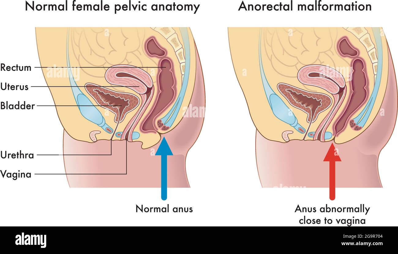 Medical illustration compares a normal female pelvic anatomy with one afflicted from anorectal malformation, with annotations. Stock Vector