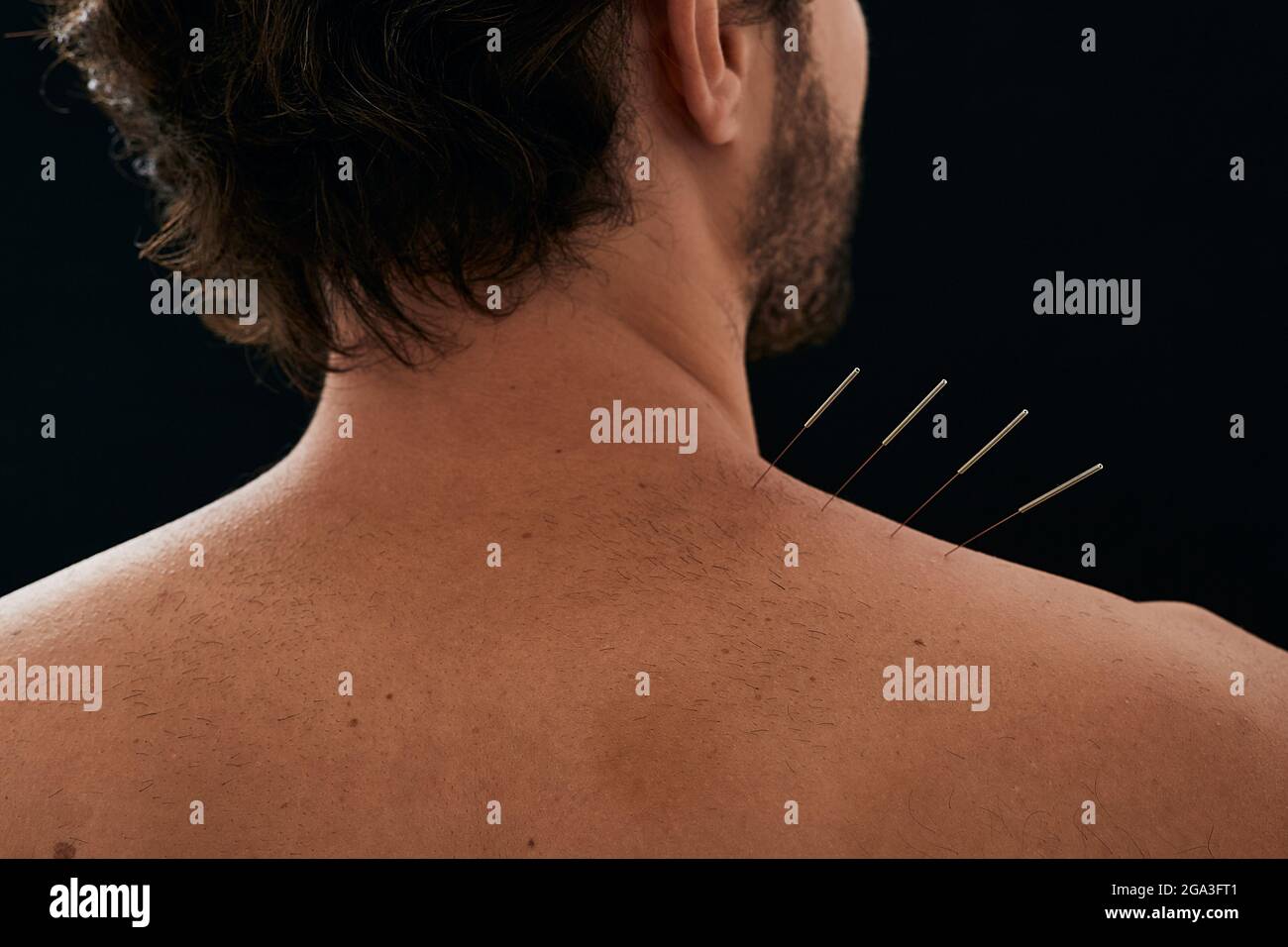 Patient's back and shoulder pain treatment with acupuncture procedure