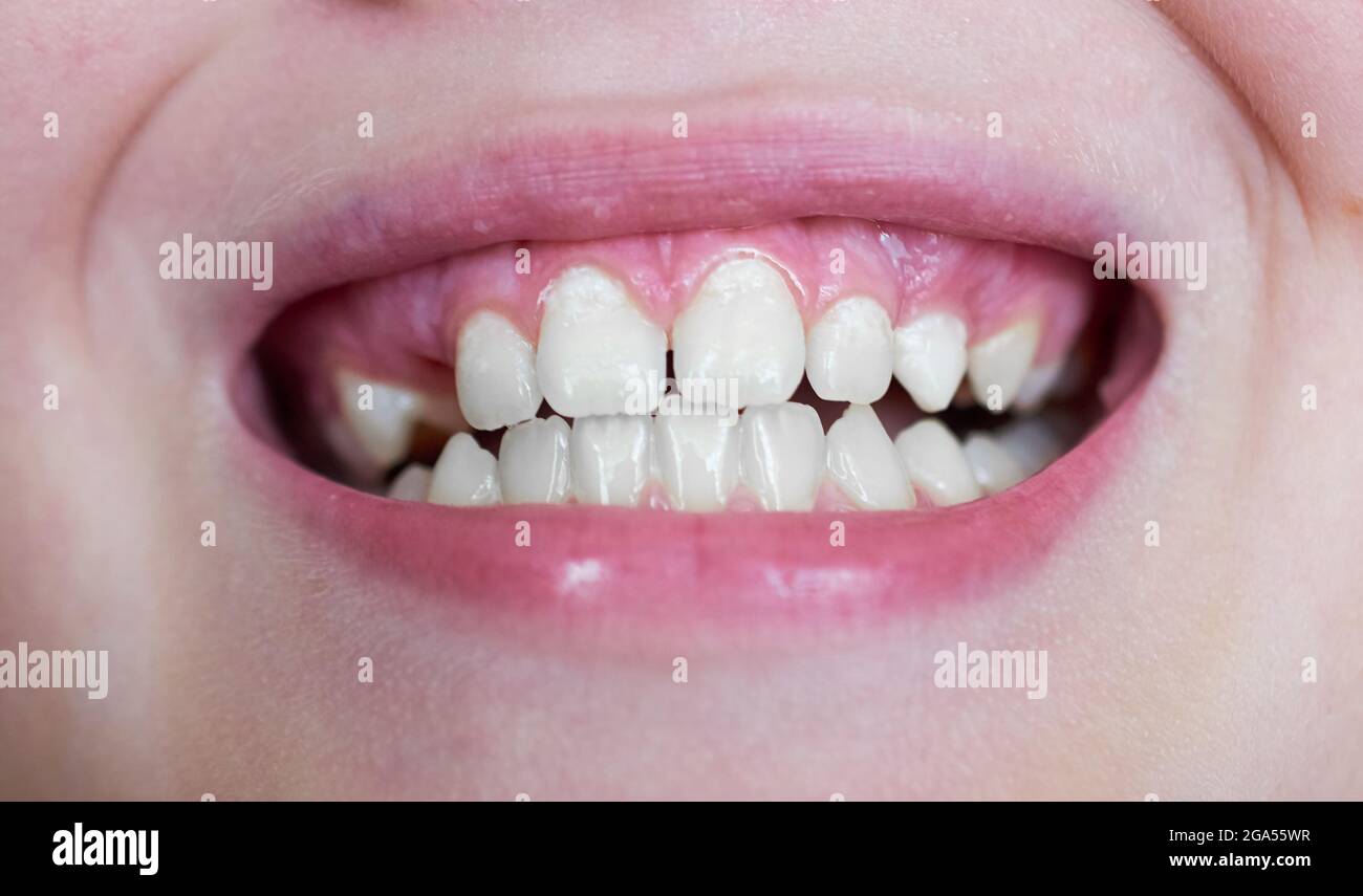 The child shows his teeth. One tooth is missing. Open mouth closeup