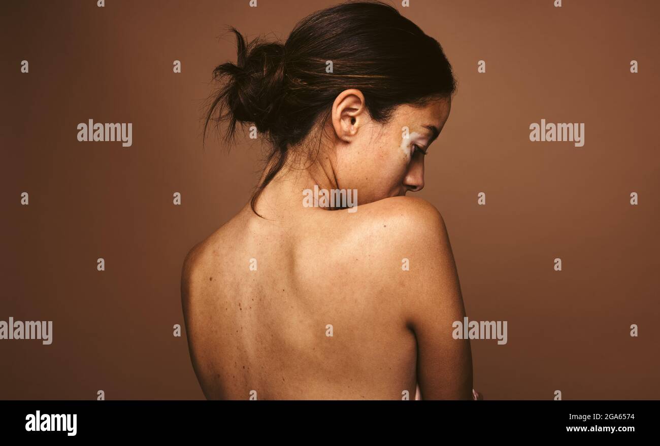 Rear view of woman with vitiligo standing against brown background. Woman having skin disease looking down. Stock Photo