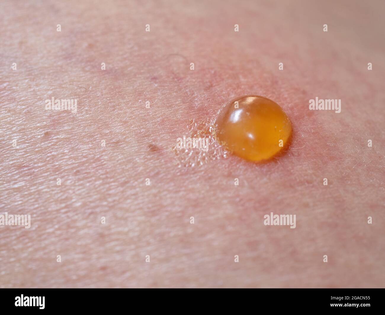 Insect bite on skin with blister Stock Photo - Alamy