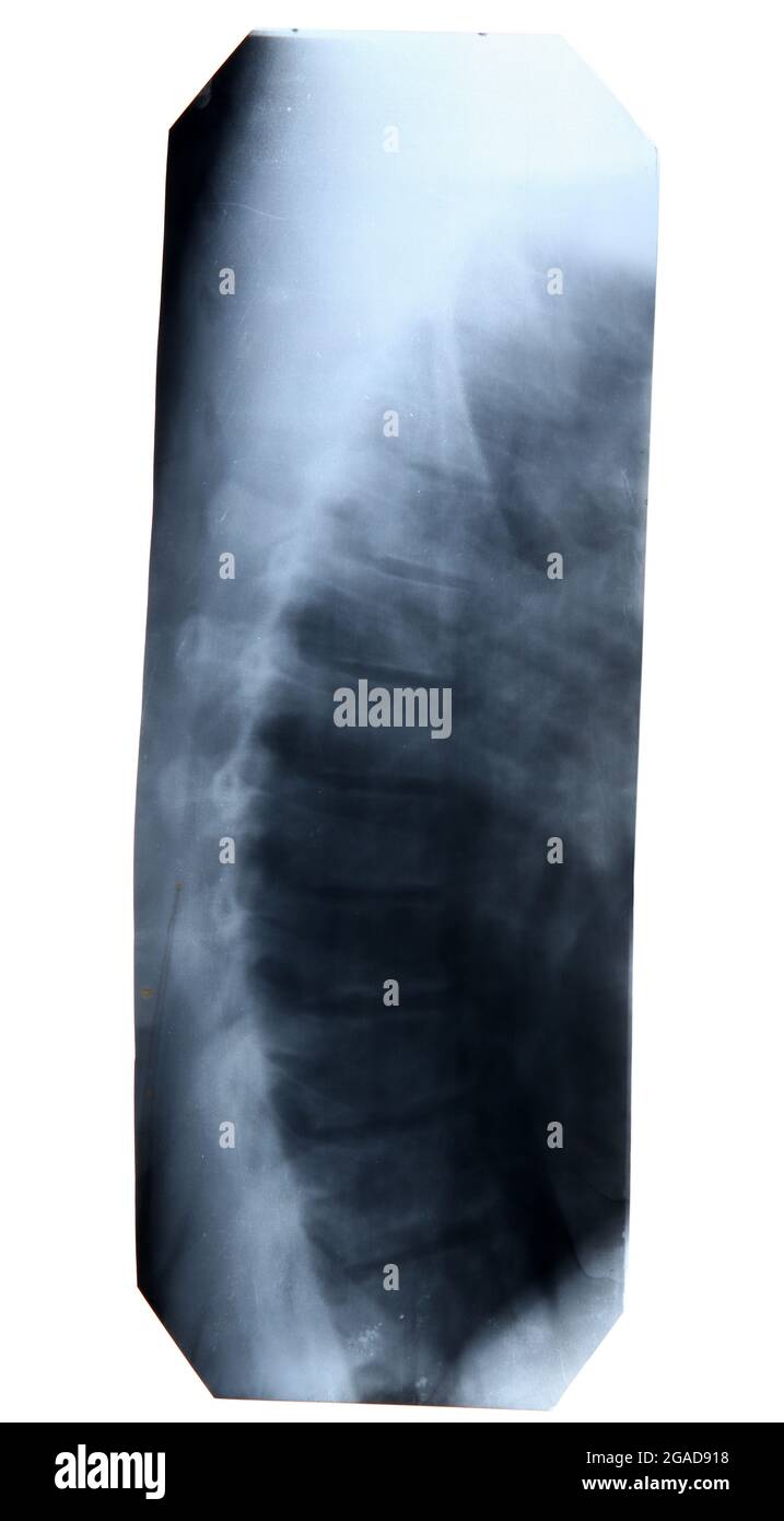 XRay image isolated on white Stock Photo Alamy
