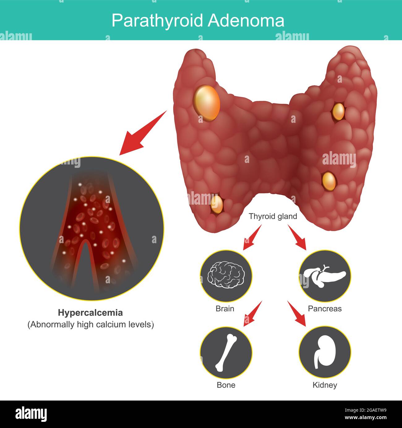 Parathyroid Adenoma. Illustration for explain abnormal thyroid gland and  include effects on other organs in human body Stock Vector Image & Art -  Alamy