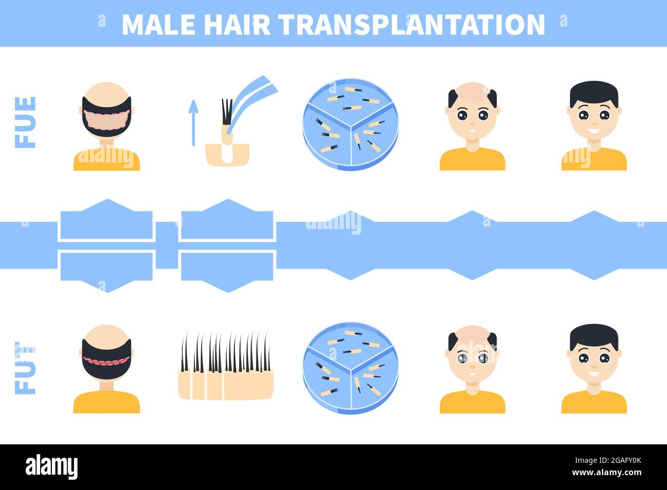 Hair transplantation in men, illustration Stock Photo