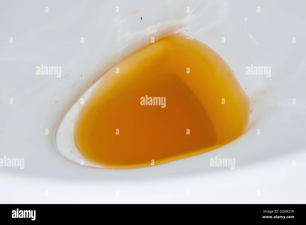 High coloured urine in toilet. High colored urine occurs in hepatitis