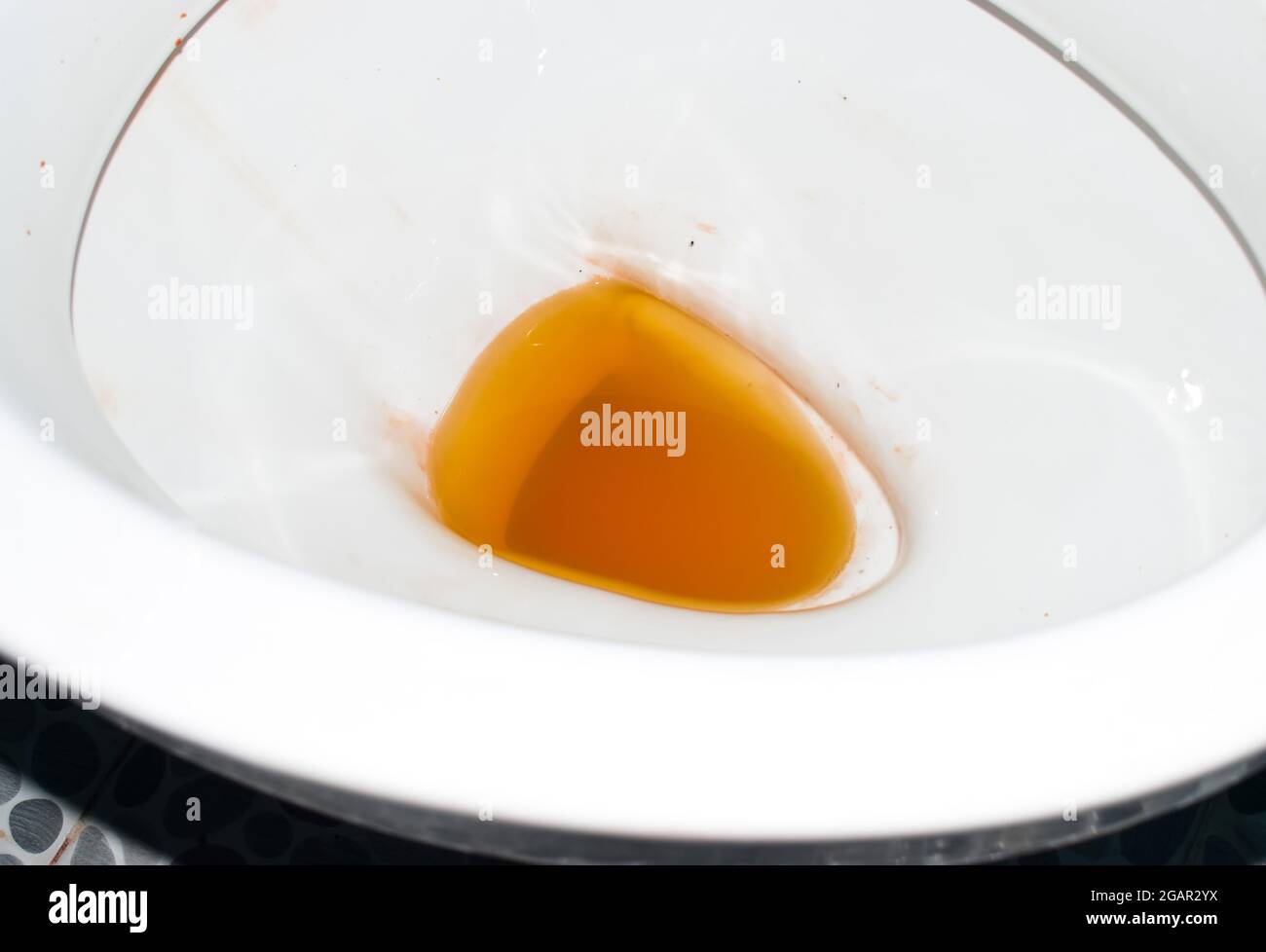 High coloured urine in toilet. High colored urine occurs in hepatitis