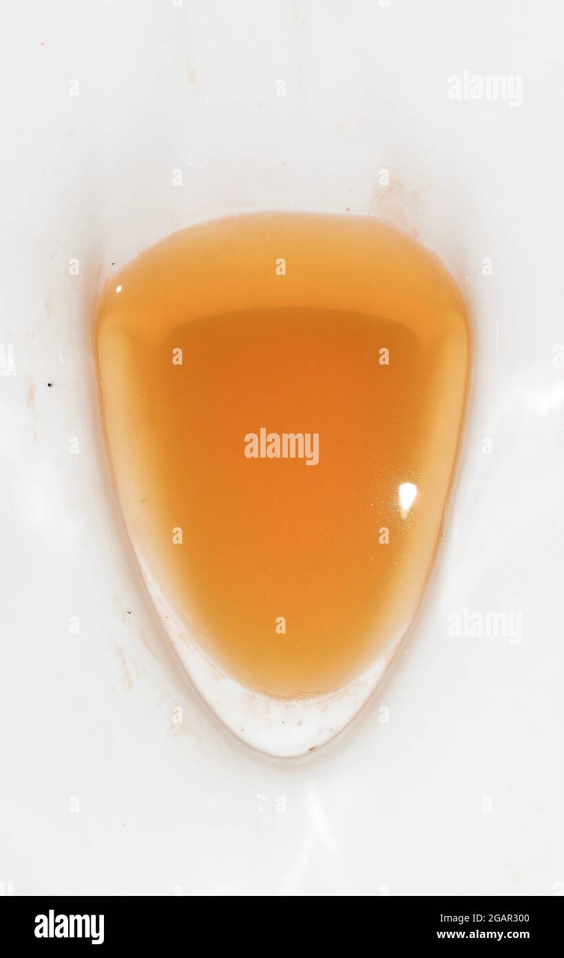 High coloured urine in toilet. High colored urine occurs in hepatitis