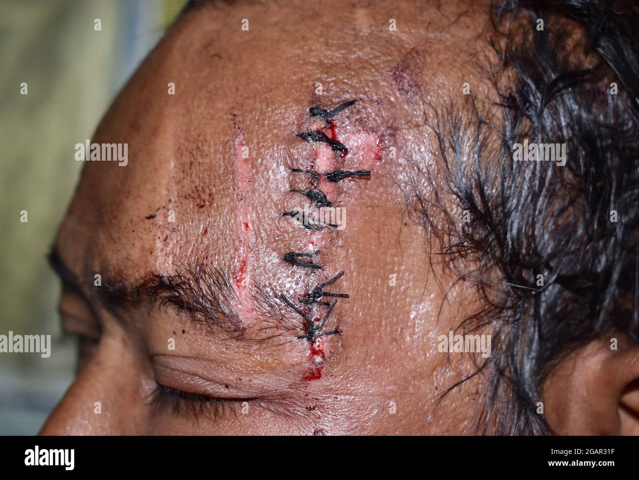 Stitched wound and abrasions  in temporal area of Southeast Asian man. Stock Photo