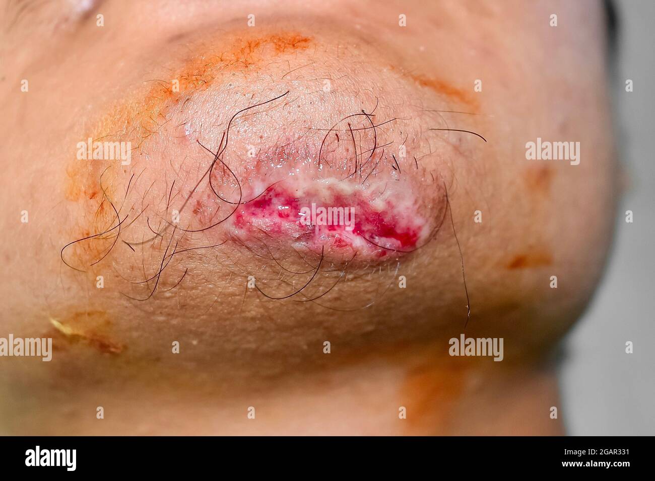 Small lacerated wound in chin of Asian man. Closeup view. Stock Photo