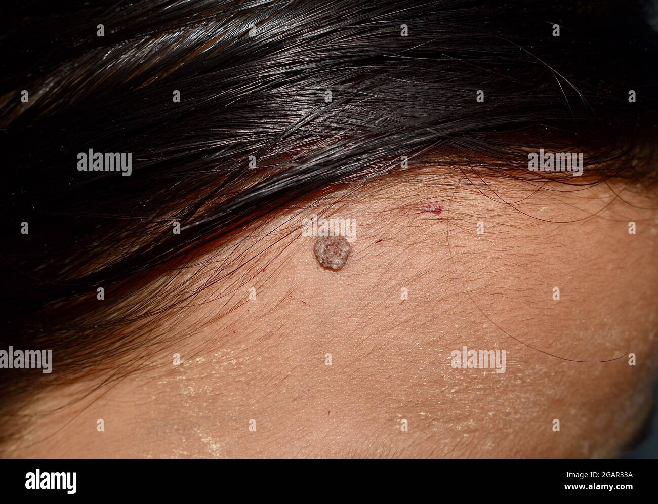 Intradermal nevus or single mole at the forehead of Southeast Asian, Myanmar young woman. It is simply a classic mole or birthmark. Stock Photo