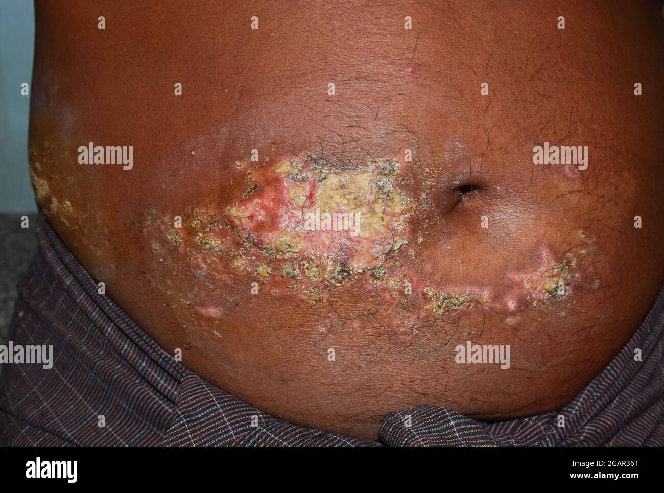 Chronic dermatitis or fungal infection in abdomen of Southeast Asian man. Stock Photo
