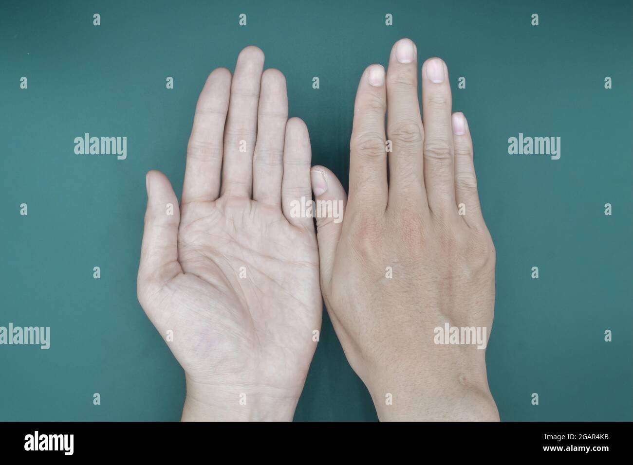 Pale palmar surface of both hands. Anaemic hands of Asian, Chinese man. Isolated on green background. Stock Photo