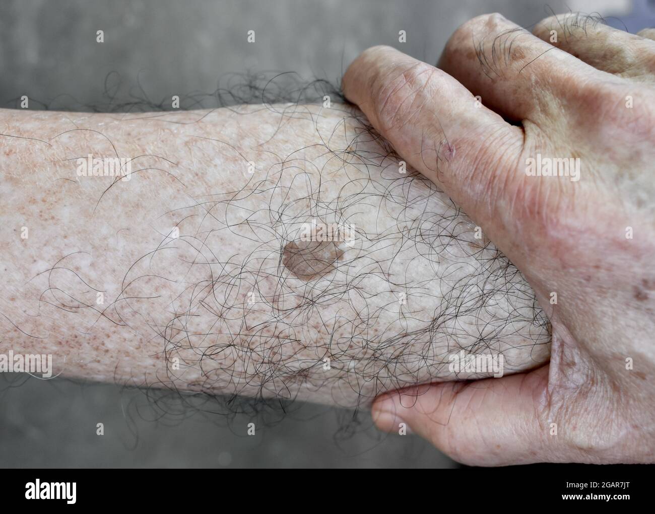Hairy Nevus High Resolution Stock Photography and Images - Alamy