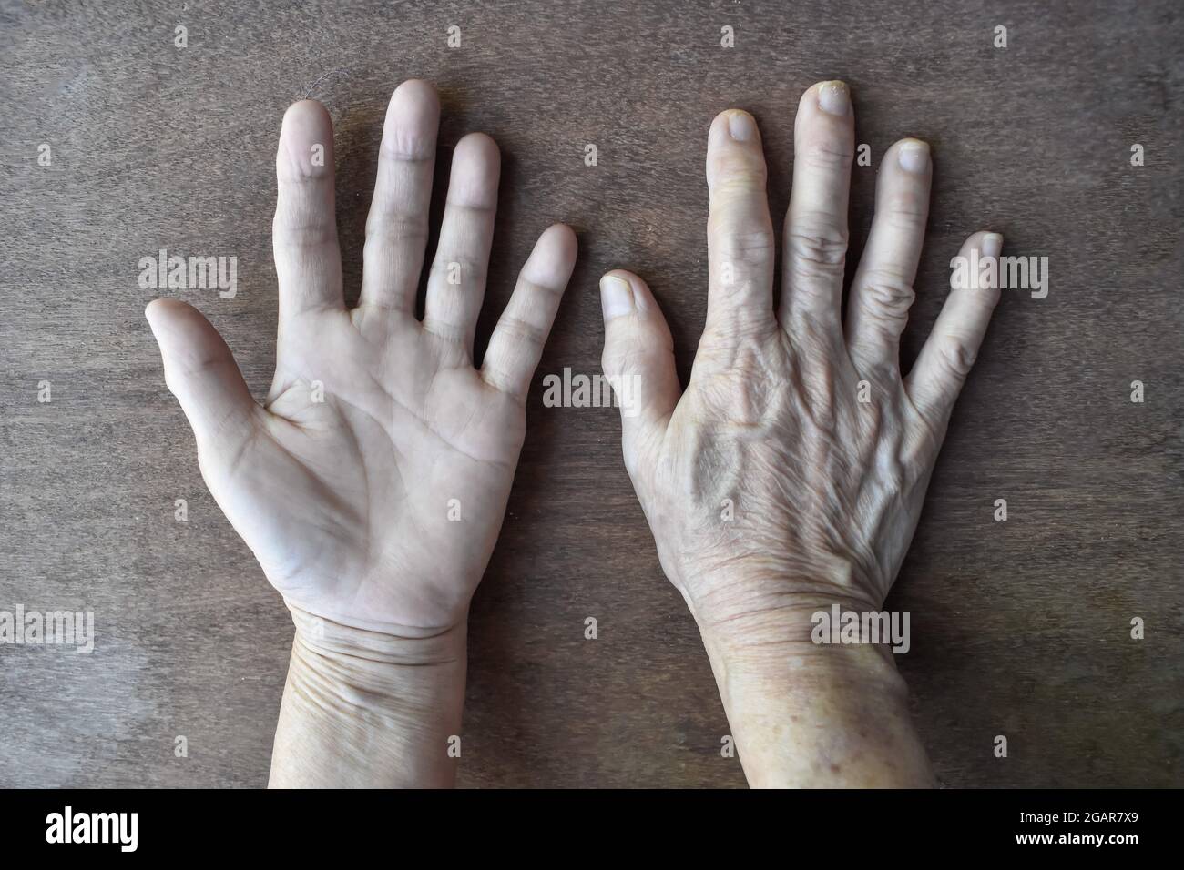 Pale palmar and dorsal surfaces of both hands. Anaemic hands of Asian, Chinese  woman. Isolated on wooden background. Stock Photo