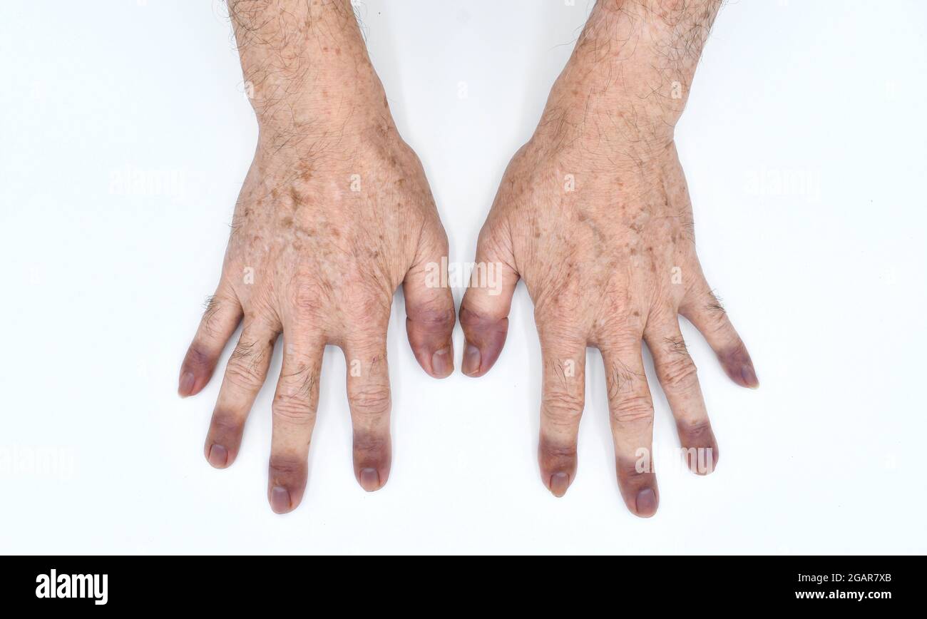 Cyanotic Hands Or Peripheral Cyanosis Or Blue Hands At Asian Man With Congenital Heart Disease Isolated On White Stock Photo Alamy