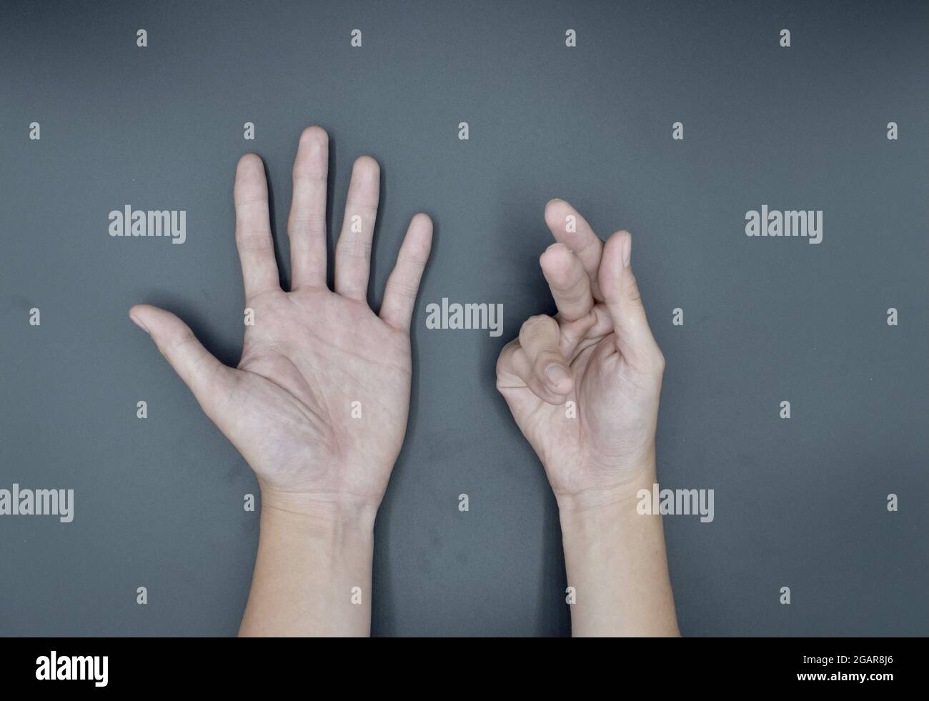 https://c8.alamy.com/comp/2GAR8J6/unilateral-dupuytrens-contracture-in-asian-young-man-unilateral-hand-deformity-abnormal-fingers-flexion-isolated-on-grey-background-2GAR8J6.jpg