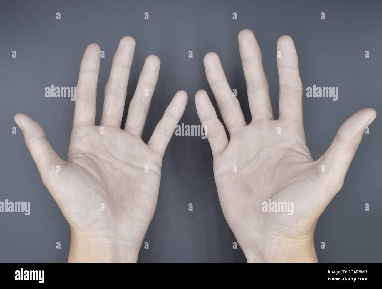 Pale palmar surface of both hands. Anaemic hands of Asian, Chinese man. Isolated on grey background. Stock Photo