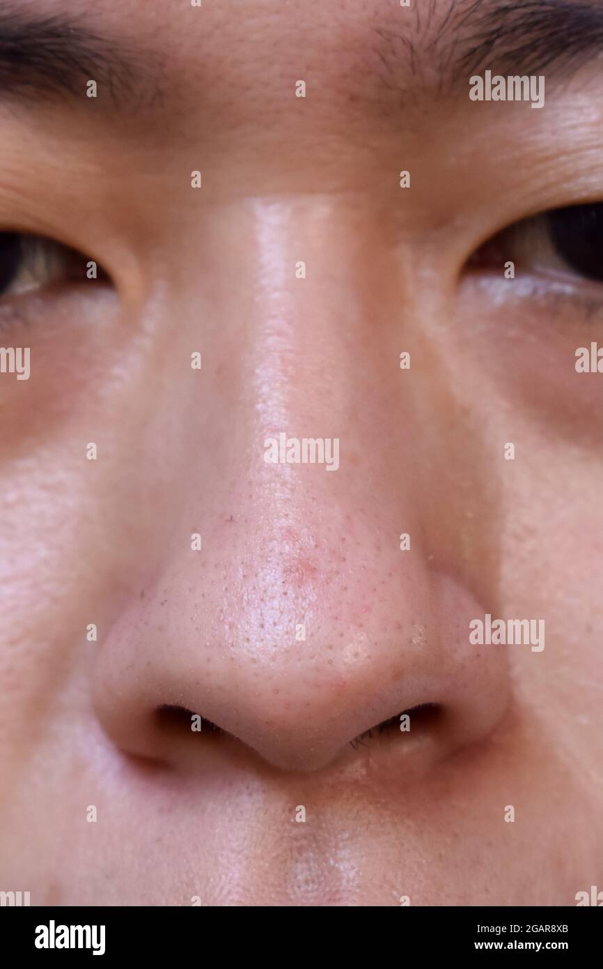 Blackheads or black heads on nose of Asian man. They are small bumps that  appear on skin due to clogged hair follicles. Closeup view Stock Photo -  Alamy