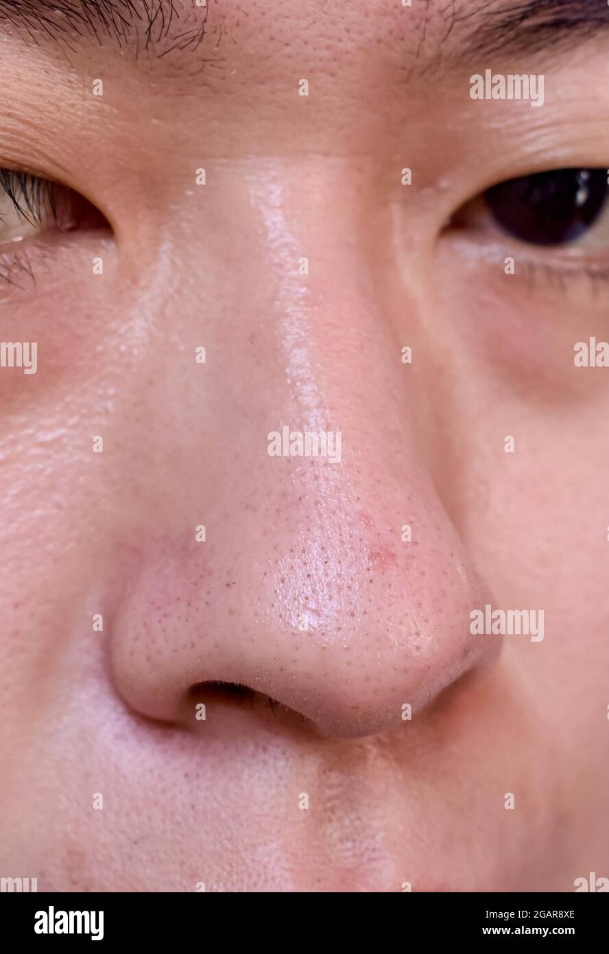 Blackheads or black heads on nose of Asian man. They are small bumps that  appear on skin due to clogged hair follicles. Right lateral view Stock  Photo - Alamy