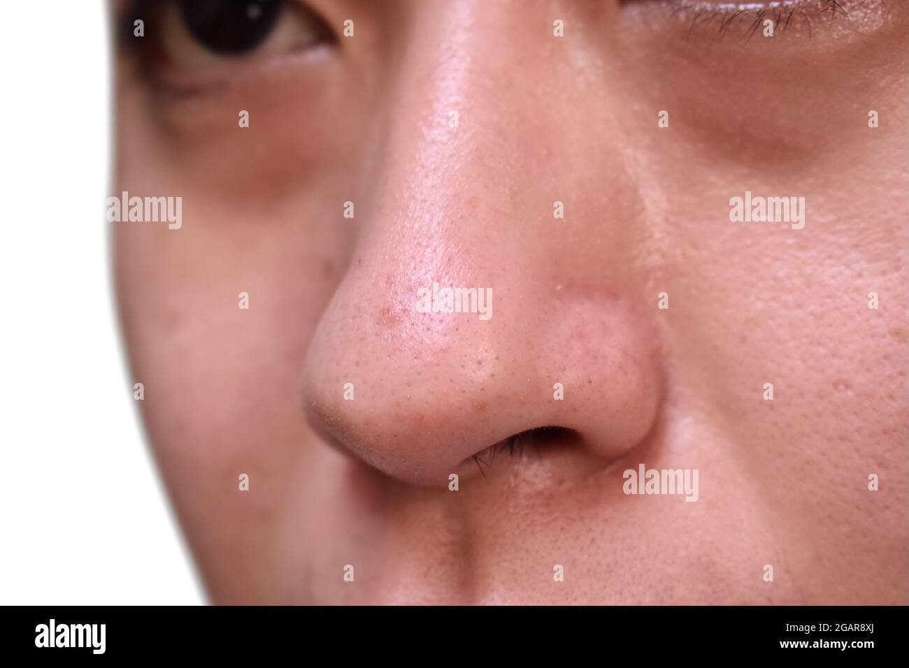 Blackheads or black heads on nose of Asian man. They are small bumps that appear on skin due to clogged hair follicles. Left lateral view. Isolated on Stock Photo - Alamy Blackheads or black heads on nose of Asian man. They are small bumps that appear on skin due to clogged hair follicles. Left lateral view. Isolated on Stock Photo - Alamy