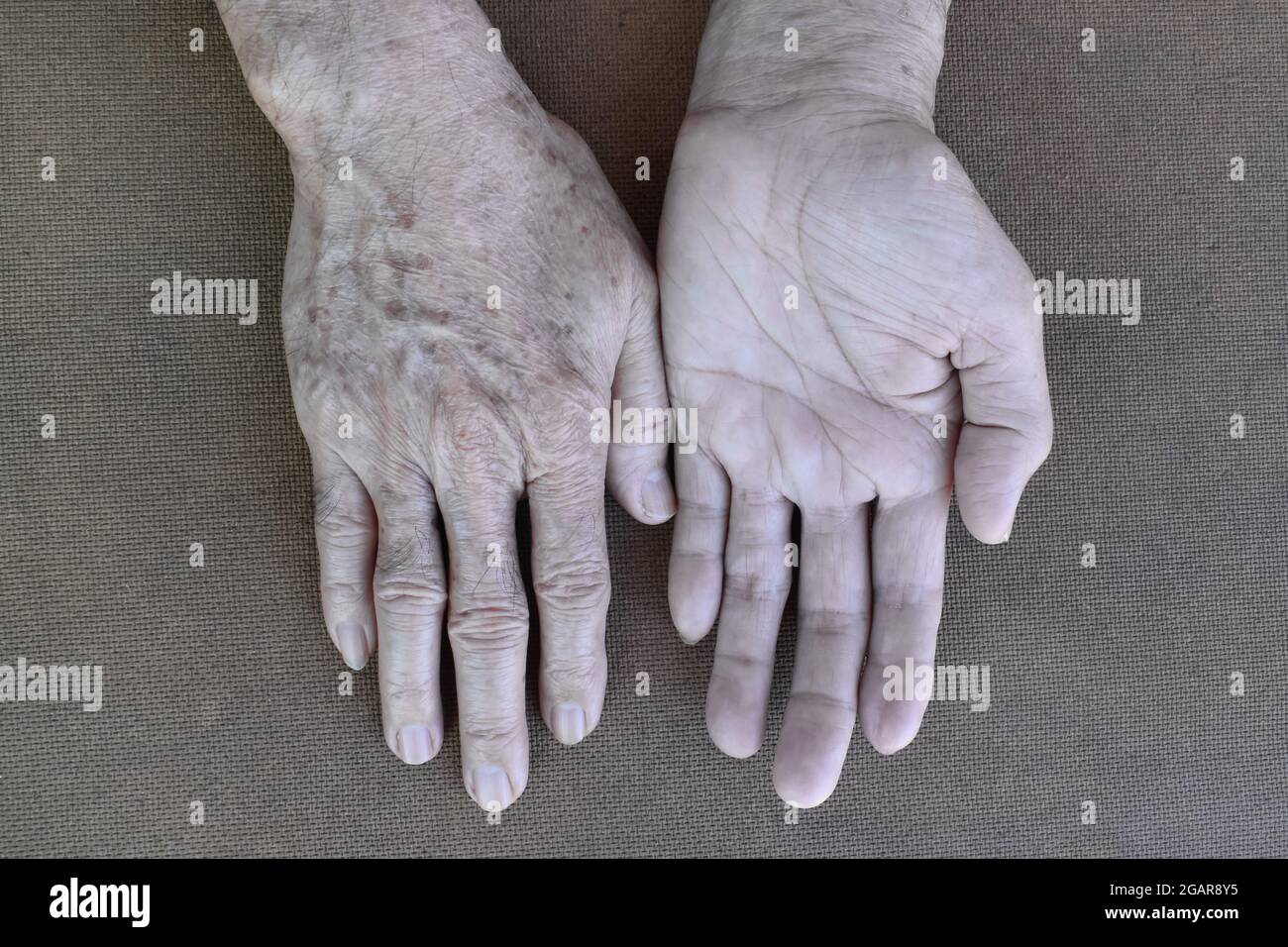 Pale palmar and dorsal surfaces of both hands. Anaemic hands of Asian, Chinese man. Isolated on wooden background. Stock Photo