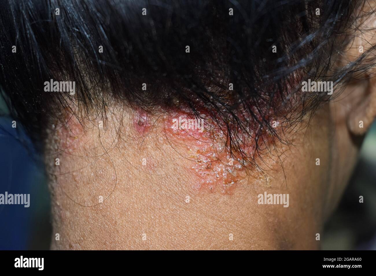 Seborrheic dermatitis or fungal skin infection at the scalp of Southeast  Asian, Myanmar adult female patient. Right lateral view Stock Photo - Alamy