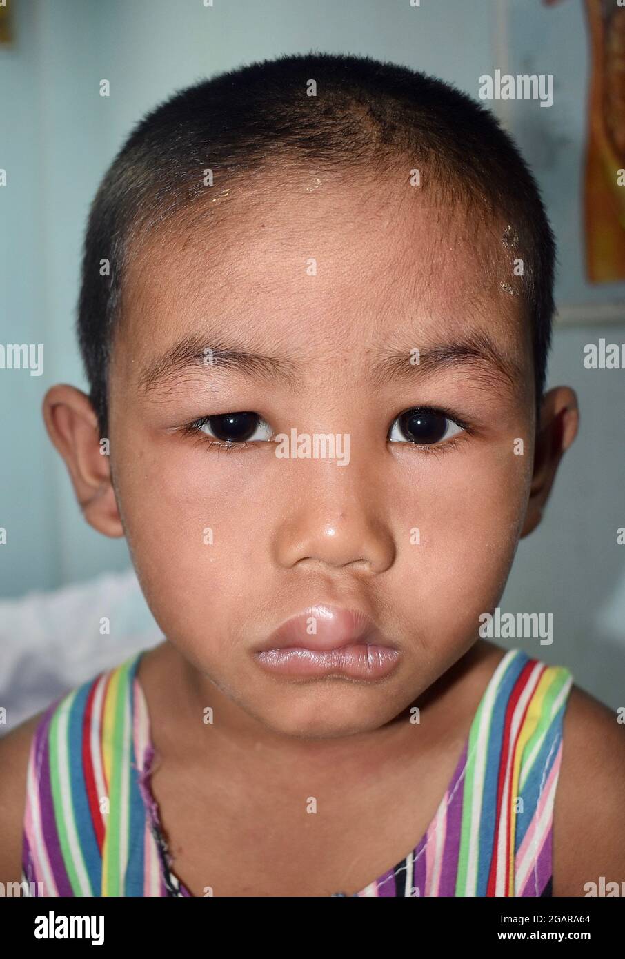 Angioedema at eyelids and lips of Southeast Asian male child. Puffy face. Edematous child. Caused by nephritis, nephrotic syndrome, drug, seafood or c Stock Photo