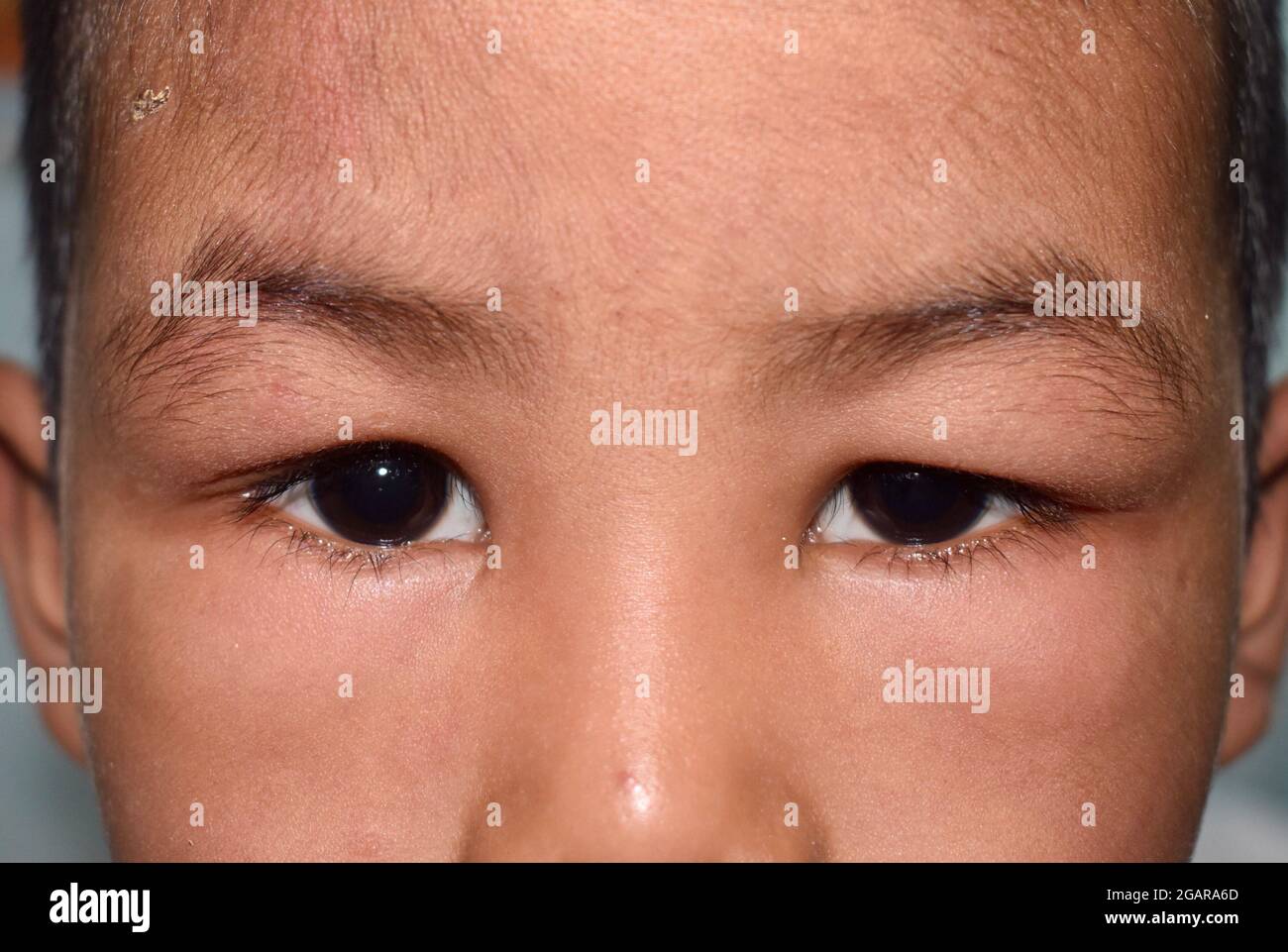 Angioedema at eyelids of Southeast Asian male child. Puffy face. Edematous child. Caused by nephritis, nephrotic syndrome, drug, seafood or chemical a Stock Photo