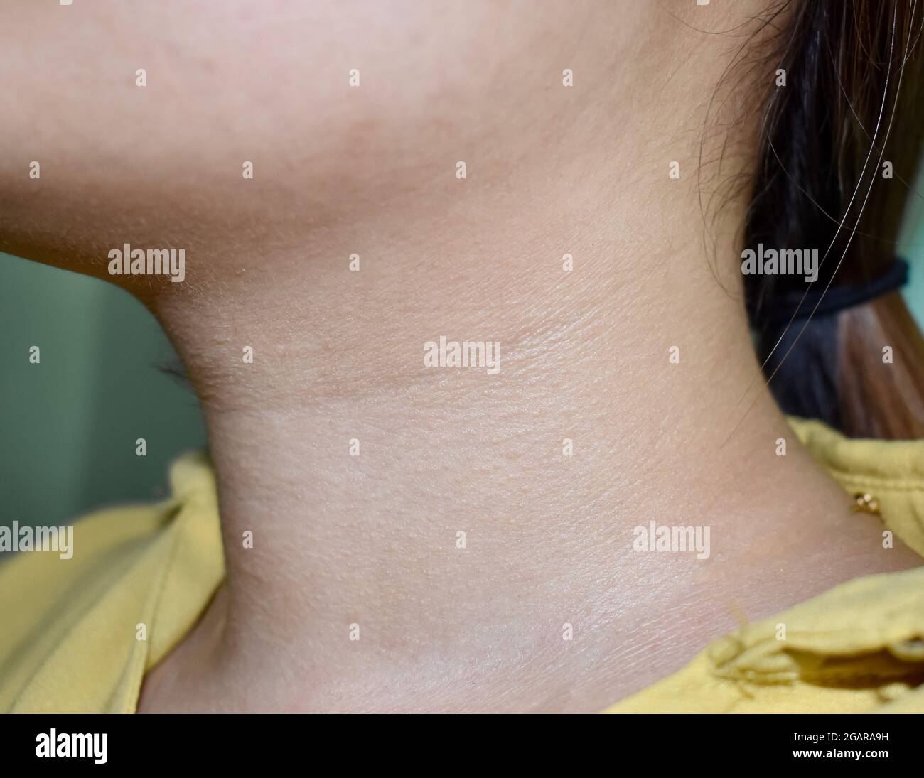 Aging skin folds or skin creases or wrinkles at neck of Southeast Asian, Chinese young woman