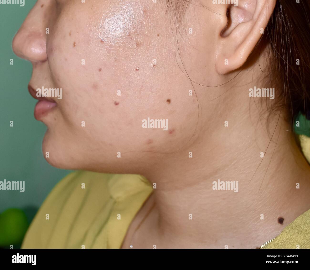 Acne vulgaris hires stock photography and images Alamy