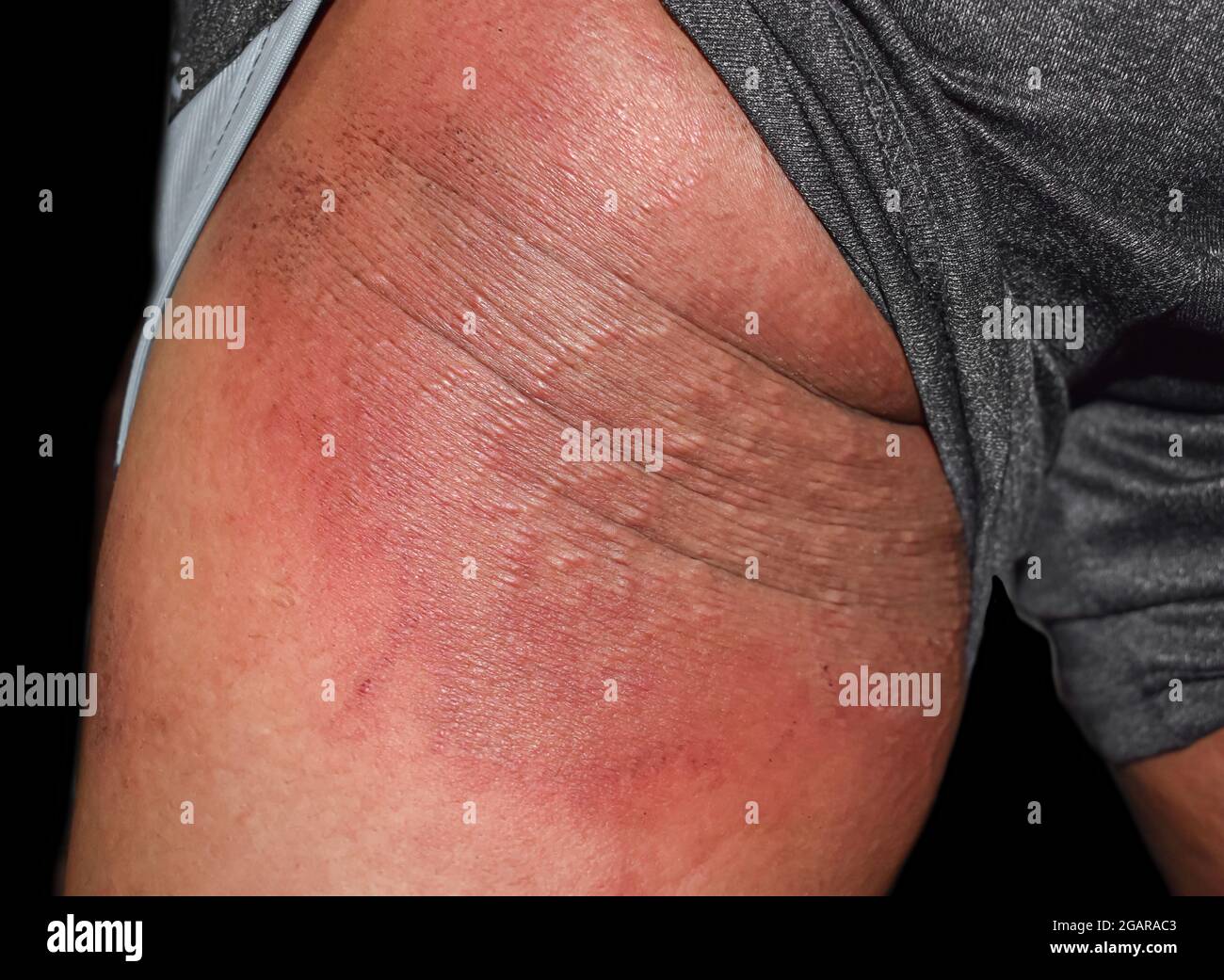 Tinea corporis at arm in Southeast Asian, Burmese young man. It is a common fungal infection and interferes with normal pigmentation of skin resulting Stock Photo
