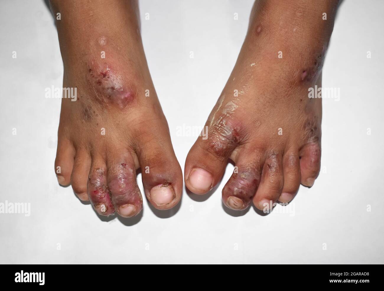 Scabies Infestation with secondary or superimposed bacterial infection and pustules in foot of Southeast Asian, Burmese baby. A contagious skin condit Stock Photo